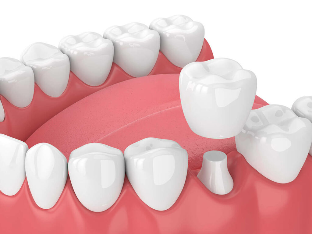 dental-crown