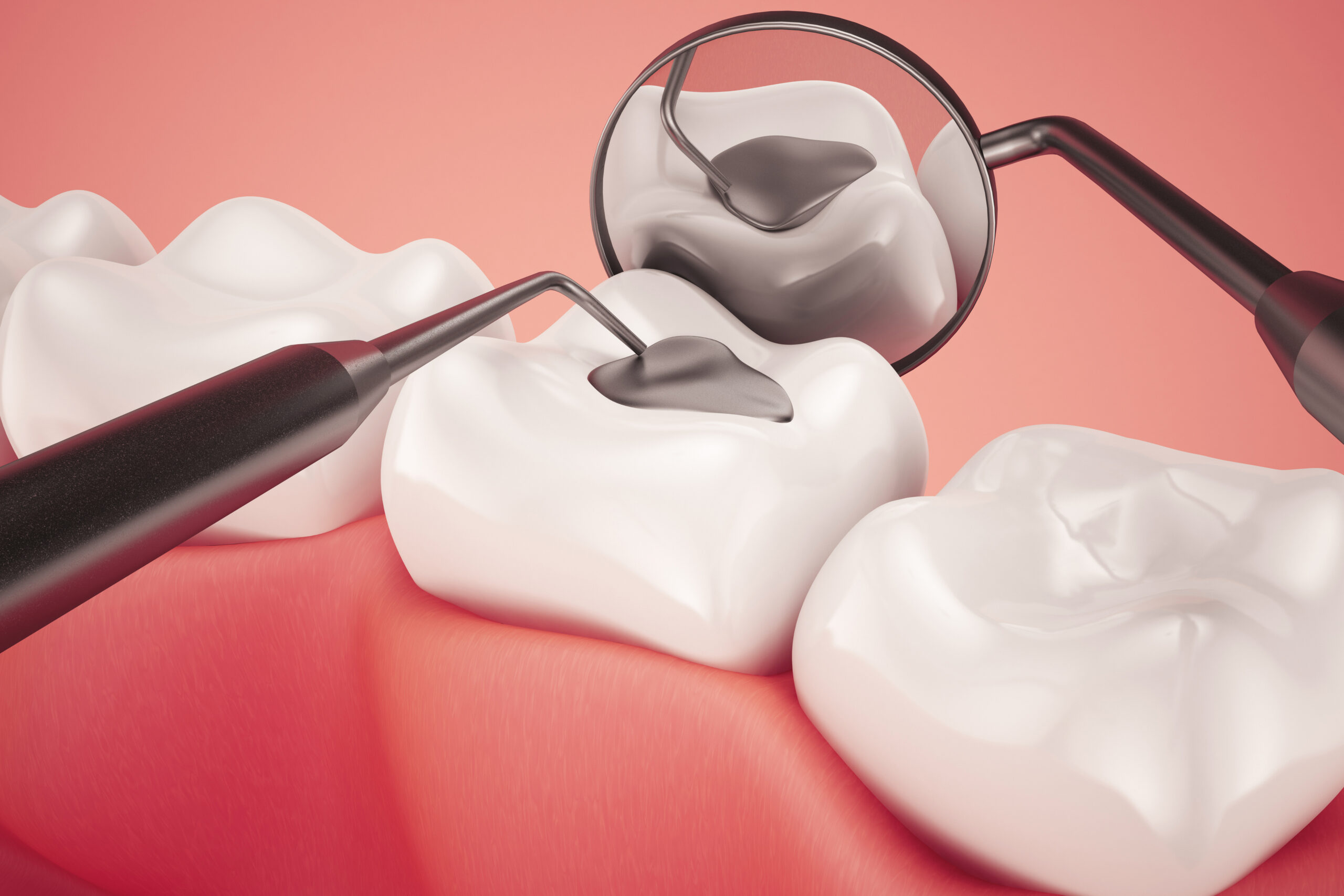dental-filling